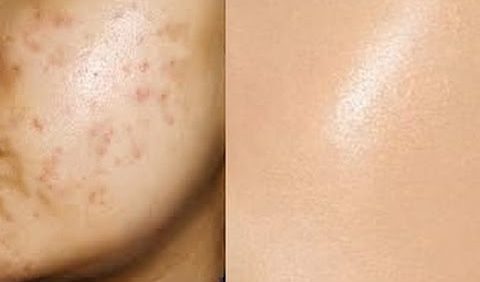 How to remove acne marks?